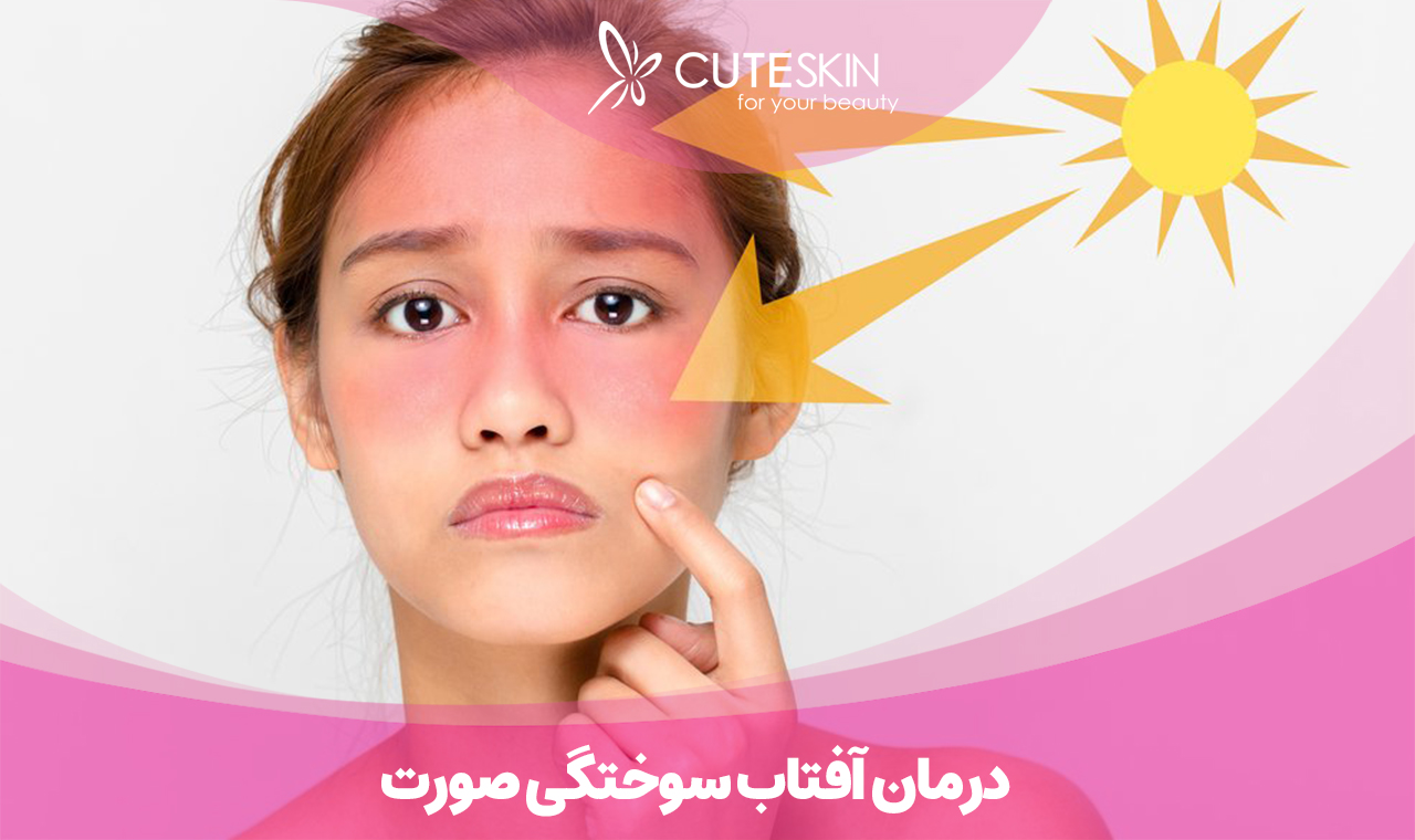 درمان آفتاب سوختگی صورت