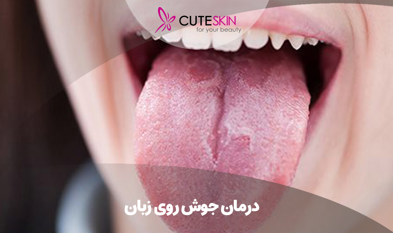 درمان جوش روی زبان