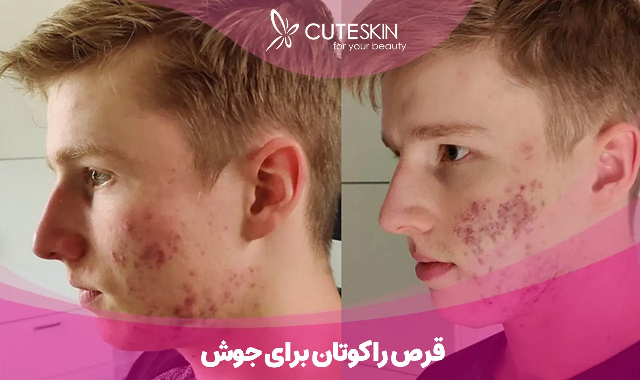 قرص راکوتان برای جوش