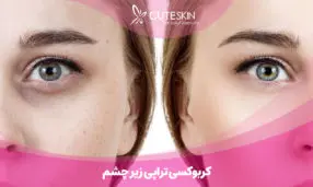 کربوکسی تراپی زیر چشم