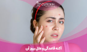 آکنه قاعدگی و علل بروز آن