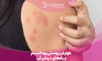 عوارض پوستی روماتیسم و راه‌های درمان آن