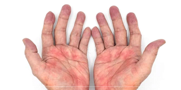 در این عفونت، یک یا چند ساختار عمیق در نواحی دست مانند تاندون‌ها، رگ‎ها و یا ماهیچه‌ها درگیر می‌شوند 