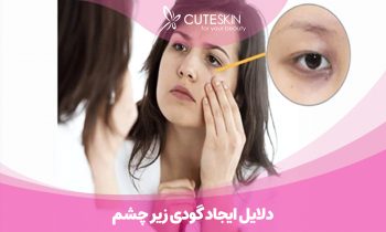 دلایل ایجاد گودی زیر چشم