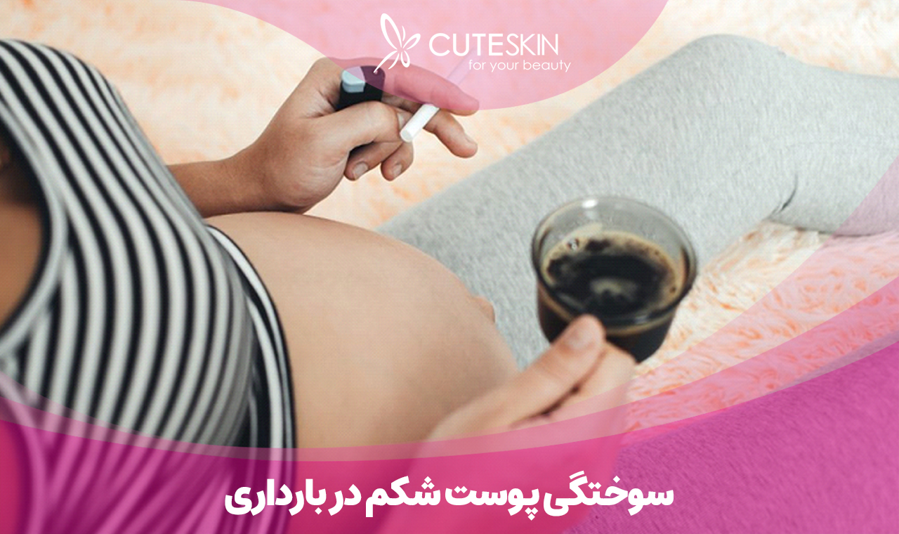 سوختگی پوست شکم در بارداری