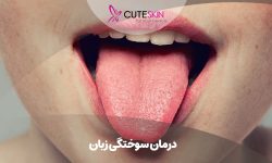 درمان سوختگی زبان